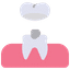 Veneers