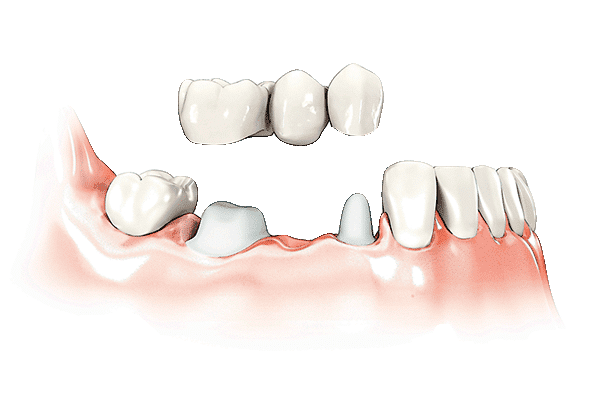 Een brug op natuurlijke tanden 1 1