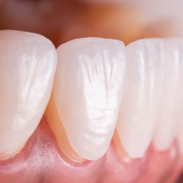 Porcelain dental 600x600
