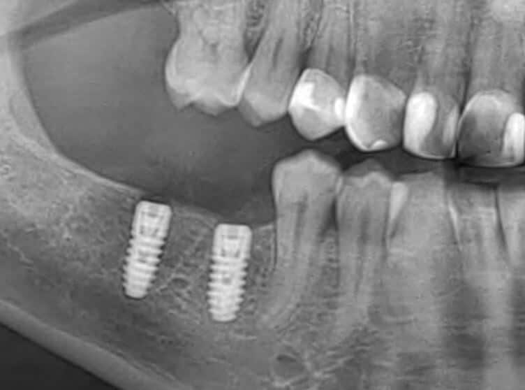 Xray 2imp 1